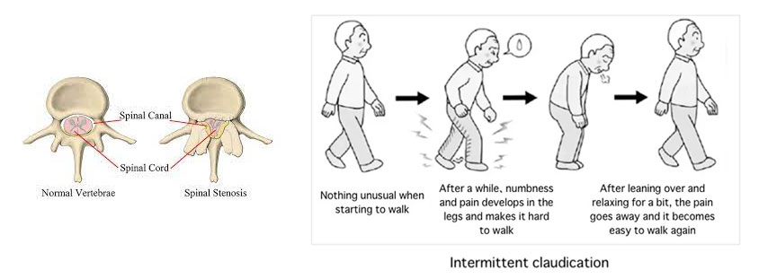 Best Lumbar Disc Prolapse Treatment in Vashi